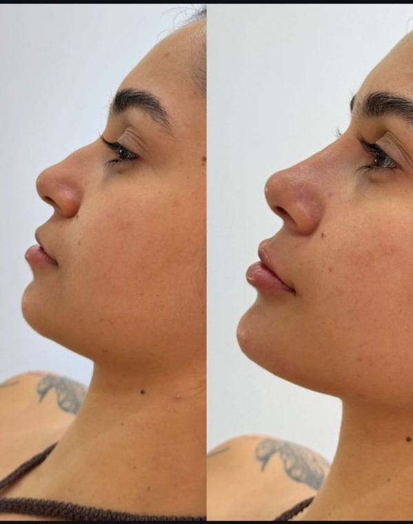 Antes e depois de perfil