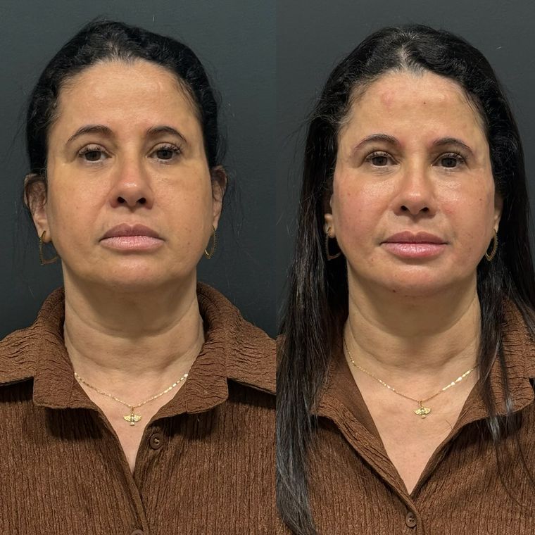 Antes e depois de frente