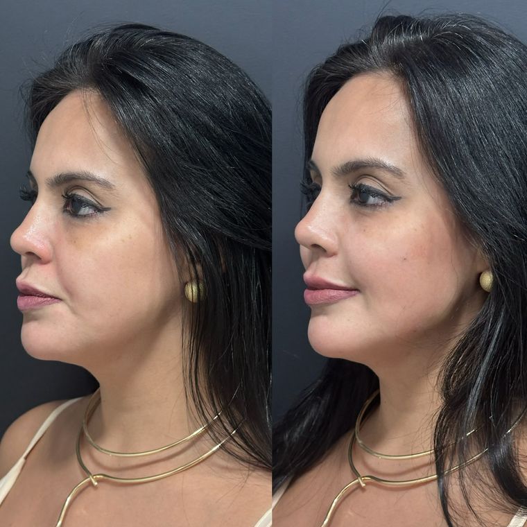 Antes e depois em vista de três quartos