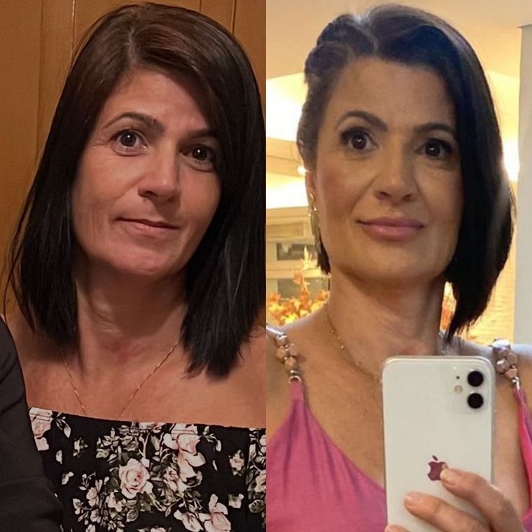 Antes e depois de frente